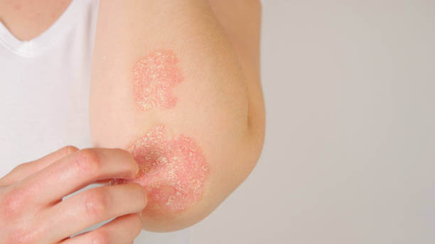 Eczema vs. Psoriasis: Differences, Symptoms, Treatments