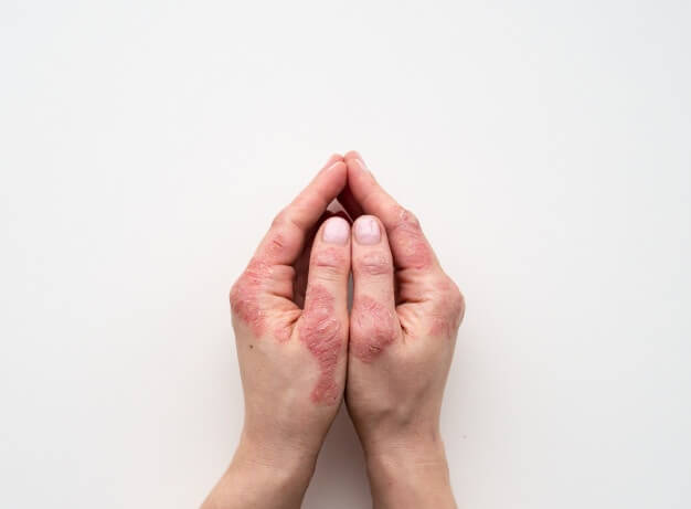 Pustular Psoriasis | Types, Diagnose, Treatment