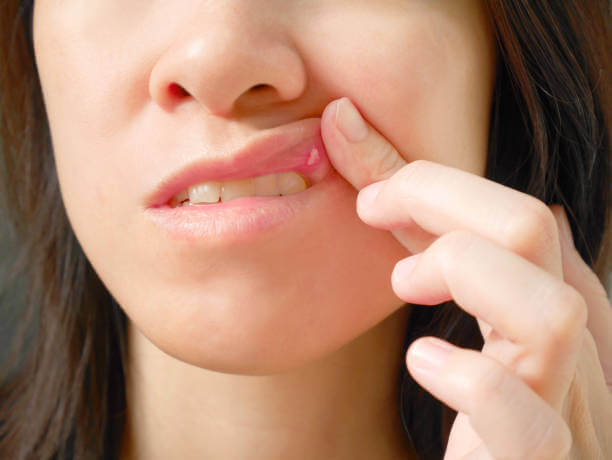 Blister on Lip | Causes, Symptoms, Treatment