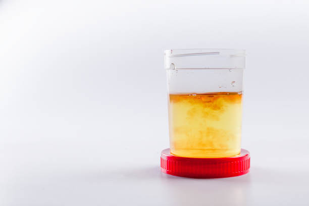 Blood in the urine (hematuria) – Symptoms and causes
