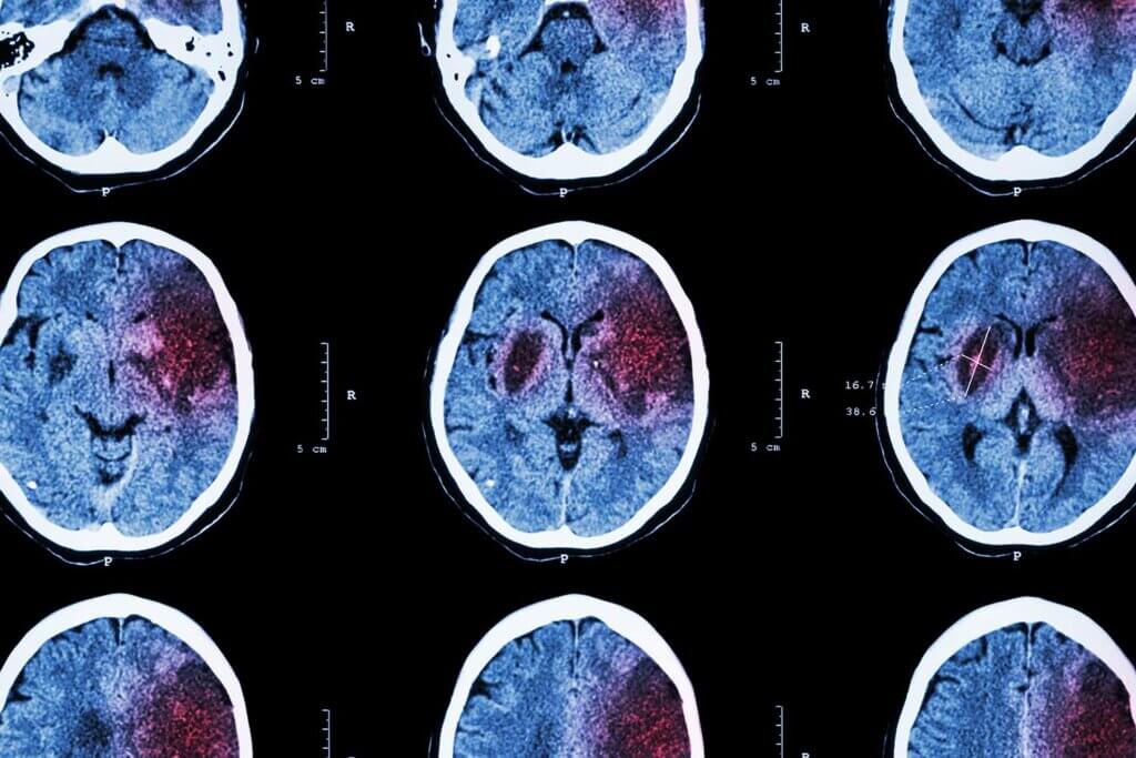 Time Sensitive Medical Emergencies 3 stroke time sensitive medical emergencies